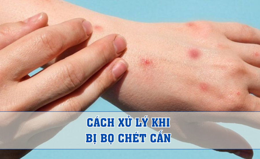 cach xu ly khi bi bo chet can